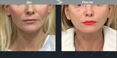 Грудной липофилинг
