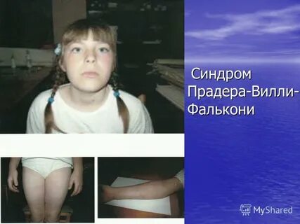 Синдром прадеда