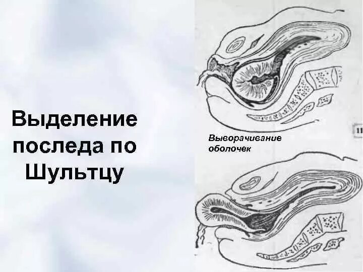 Выделение последа. Выделение последа по шульце. отделение плаценты по шульцу. выделение плаценты по шульце.