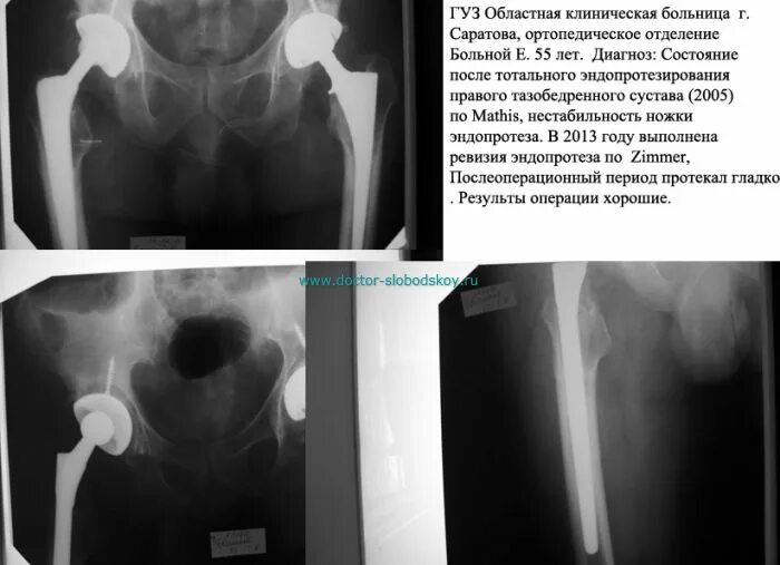 Картинки КЛИНИЧЕСКИЕ РЕКОМЕНДАЦИИ ЭНДОПРОТЕЗИРОВАНИЕ