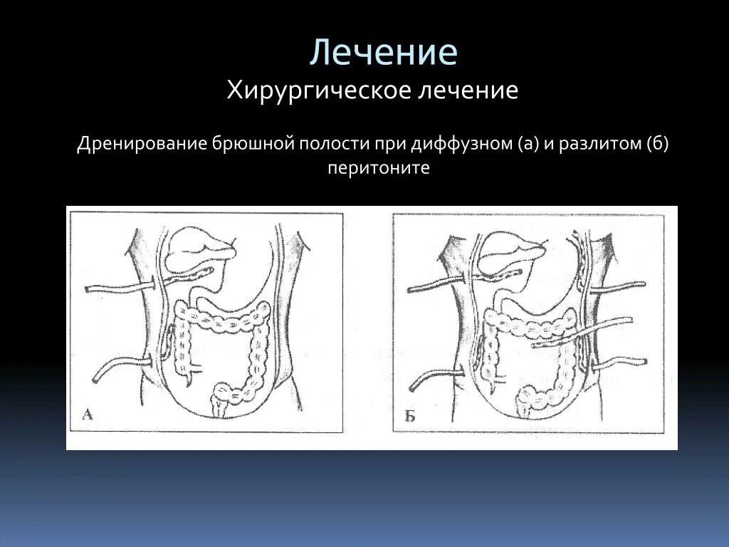 Лечение перитонита операция. Дренирование брюшной полости. Операция при перитоните. Схема дренирования брюшной полости при перитоните. Перитонит дренирование.