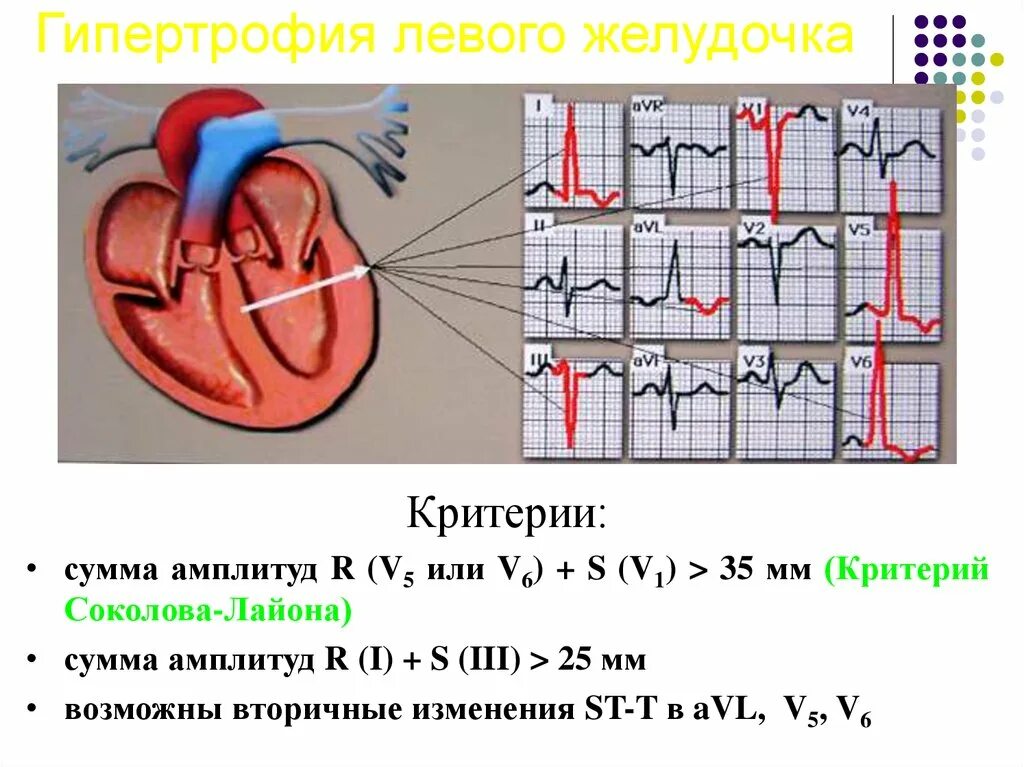 Гипертрофия отделов сердца. Гипертрофия левых отделов сердца на ЭКГ. Гипертрофия правого желудочка на ЭКГ. Гипертрофия левого желудочка сердца на ЭКГ. Гипертрофия левого предсердия левого желудочка