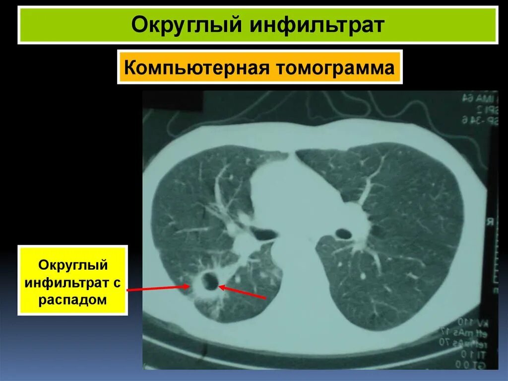 Округлый инфильтрат