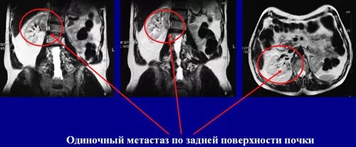 Что входит в мрт забрюшинного пространства. Мрт забрюшинного пространства. метастазы в забрюшинное пространство. метастазы брюшной полости на мрт. мрт анатомия забрюшинного пространства.