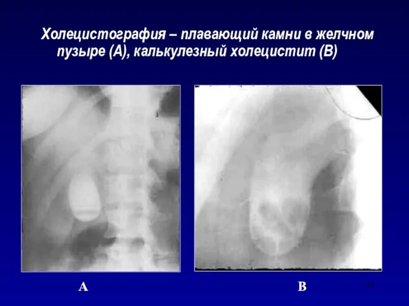 Пероральная холецистография. Холецистография желчного пузыря. Холесцинтиграфия. Холецистография заключение.