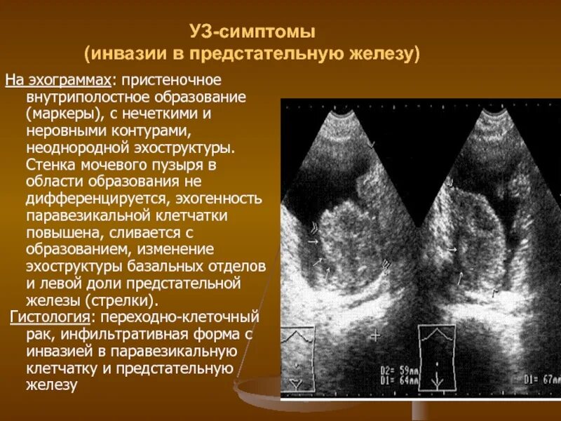 Эхогенность предстательной железы. Образования простаты на УЗИ. Образование в предстательной железе. Эхогенность предстательной железы на УЗИ.