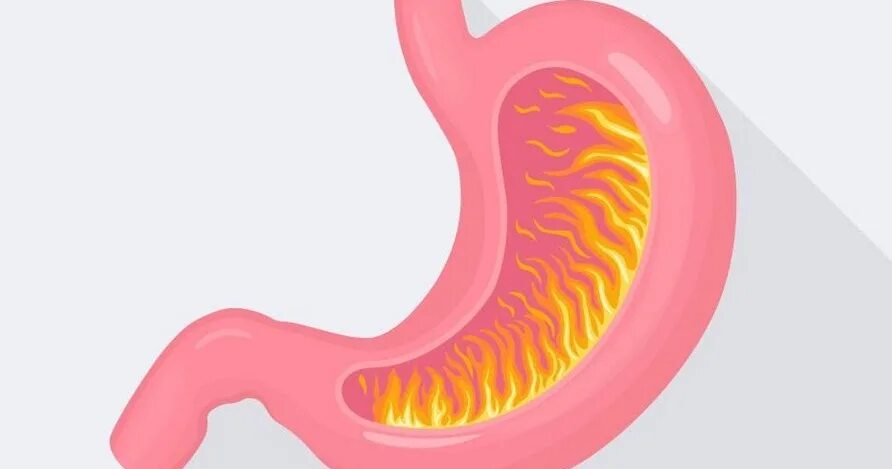 Изжога гифка. Изжога при язве
