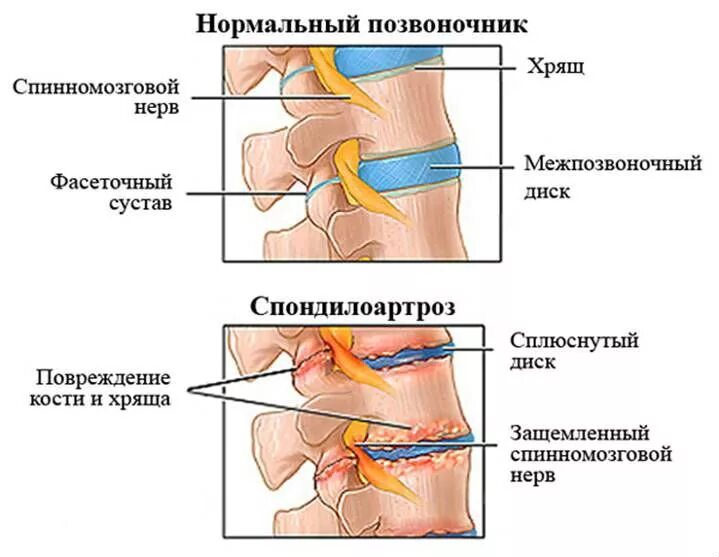 Спондилоартроз пояснично-крестцового отдела позвоночника. Спондилоартроз l1-s1 пояснично-крестцового отдела позвоночника. Спондилоартроз l2-s1 что это такое. Спондилоартроз пояснично-крестцового отдела 2 степени.