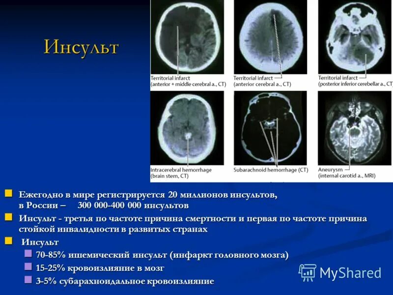 Инсульт 3 день