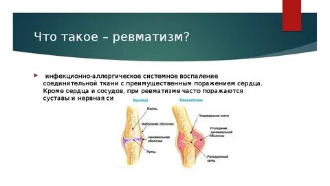 Что такое ревматизм