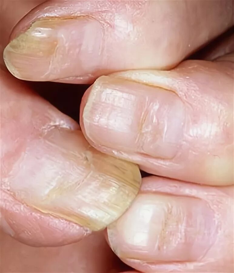 Почему ногти стали ребристыми вертикально. Онихорексис, ониходистрофия. Ониходистрофия (дистрофия ногтей). Срединная каналообразная ониходистрофия. Ониходистрофия Хеллера.