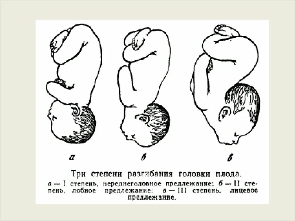 Головное предлежание плода роды. Головное лобное предлежание плода. Головное предлежание плода лицевое. Переднеголовное лобное лицевое предлежание. Переднеголовное предлежание