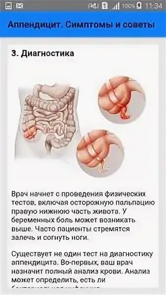 Признаки аппендицита у женщин как определить. Признаки аппендицита у женщин как определить