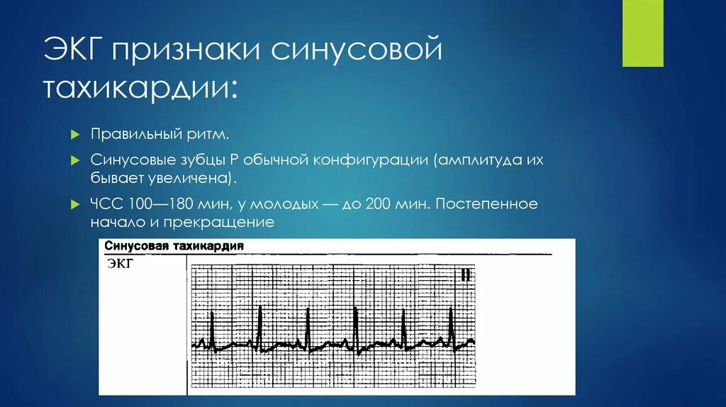 Сильное сердцебиение при нагрузках. Изменения на ЭКГ при синусовой тахикардии. ЭКГ тахикардия синусовый ритм ЧСС 90. ЭКГ критерии синусовой тахикардии. ЭКГ проявления синусовой тахикардии.