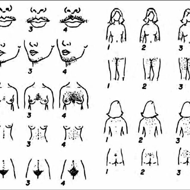 Шкала Ферримана-Голлвея гирсутизм для женщин. Гирсутизм шкала Ферримана. Гирсутизм и вирилизация. Шкала Ферримана Голлвея. Вирилизация это