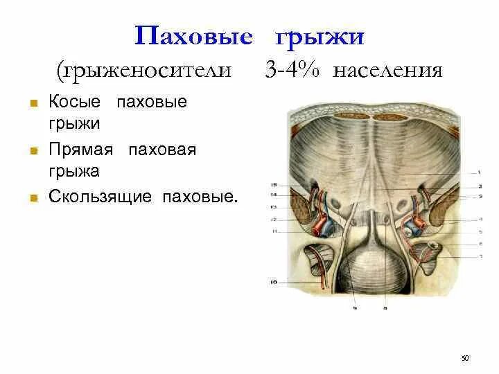 Косые и прямые паховые грыжи схема. Косая паховая грыжа паховая ямка. Пряма ЯИ косая паховавя грыжа. Прямая и косая паховые грыжи