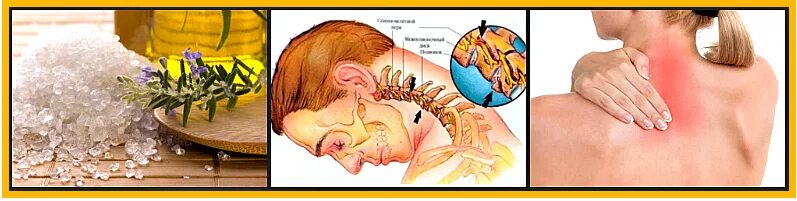 Отложение солей в шейном отделе. Отложение солей в позвоночнике. Компрессы при остеохондрозе