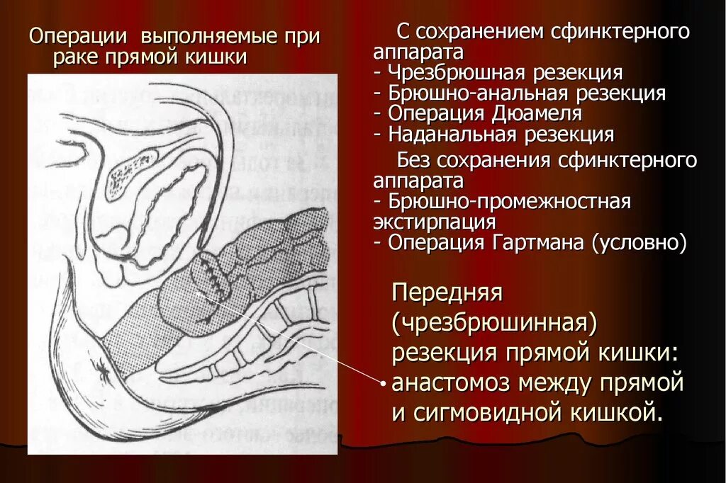 Операции через прямую кишку. Чрезбрюшная резекция прямой кишки. Брюшноанальную экстирпацию прямой кишки. Передняя резекция прямой кишки. Внутрибрюшная передняя резекция прямой кишки.