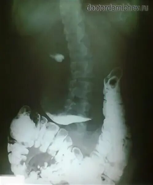 Гастроптоз 3 степени. Гастроптоз степени рентген. Гастроптоз 3 степени рентген. Гастроптоз 3 степени рентген. Опущение желудка рентген.