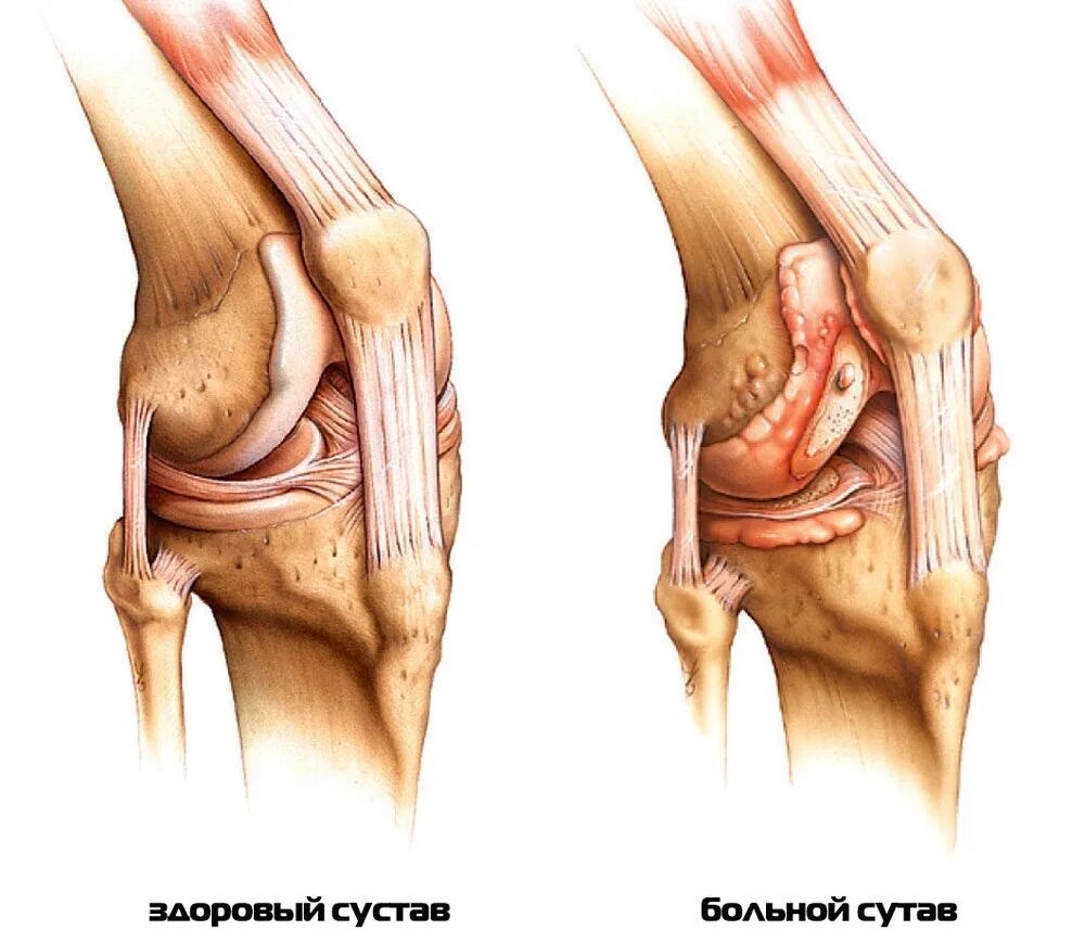 Медиопателлярная связка коленного сустава. Остеоартрит коленного сустава. Заболевания суставов коленей. Деформирующем остеоартрозе симптомы. Деформирующий остеоартрит остеоартроз.