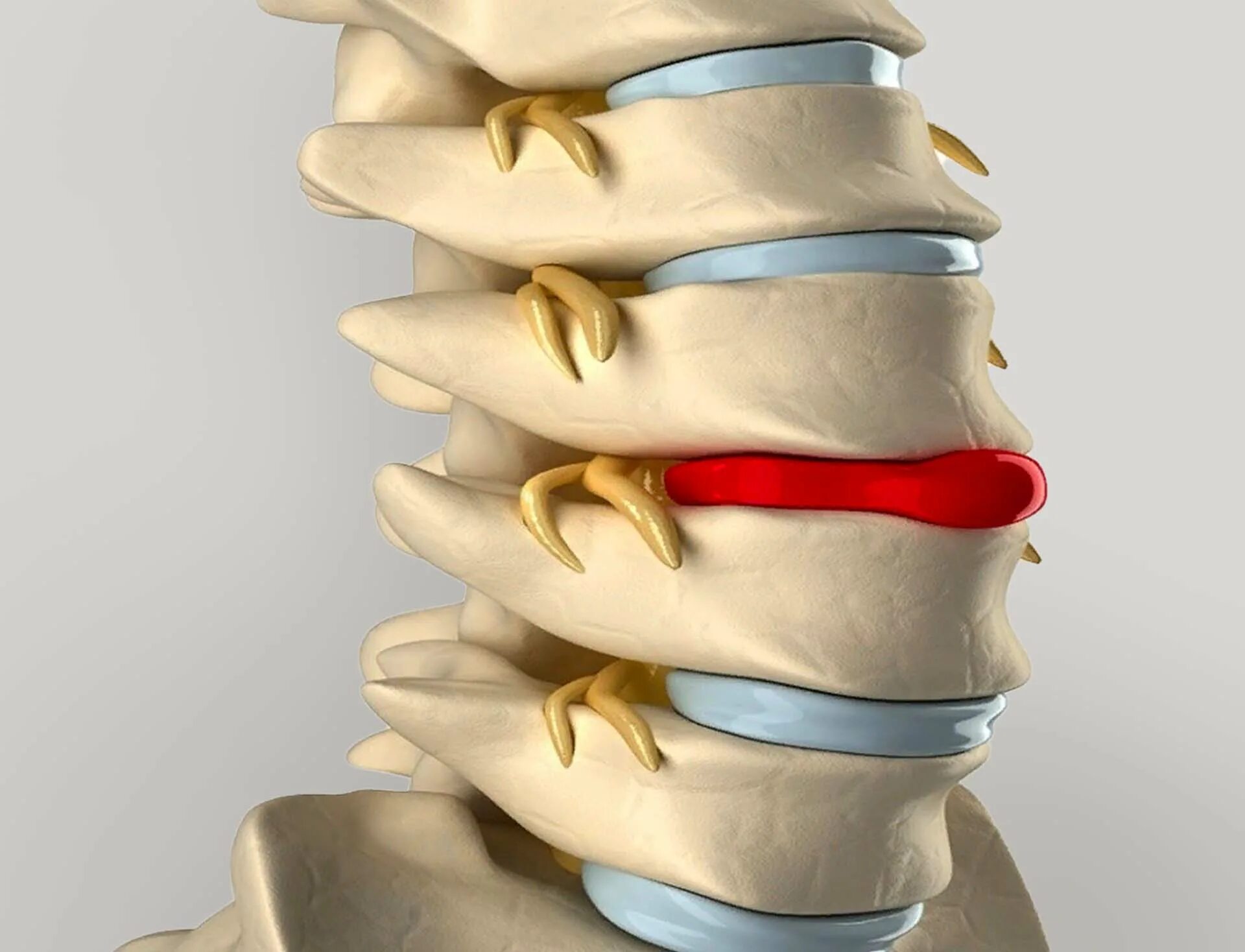Спинные диски. Грыжа межпозвоночного диска. Грыжа межпозвонквого дискапозвонок. Междисковая грыжа позвоночника. Грыжи и протрузии позвоночника.