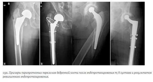 Замена т б сустава. Перелом эндопротеза тазобедренного сустава. Ревизионное тотальное эндопротезирование тазобедренного сустава:. Перипротезный перелом тазобедренного сустава. Перелом шейки бедра рентген протез.