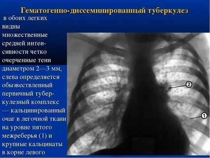 Очаг в верхней доле левого легкого