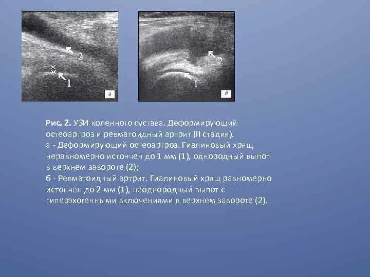 Выпот в полости коленного сустава. Остеоартроз коленного сустава УЗИ протокол. Артроз коленного сустава УЗИ протокол. Гиалиновый хрящ коленного сустава на УЗИ. УЗИ коленного сустава артрит протокол.