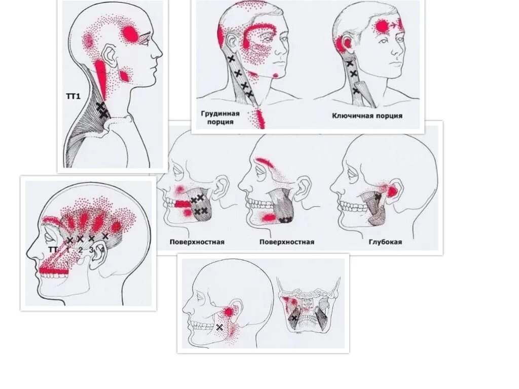 Болезненные точки на голове. Головная боль триггерные точки. Мышцы шеи и лица триггерные точки. Карта триггерных точек головы и шеи. Миофасциальный синдром триггеры.