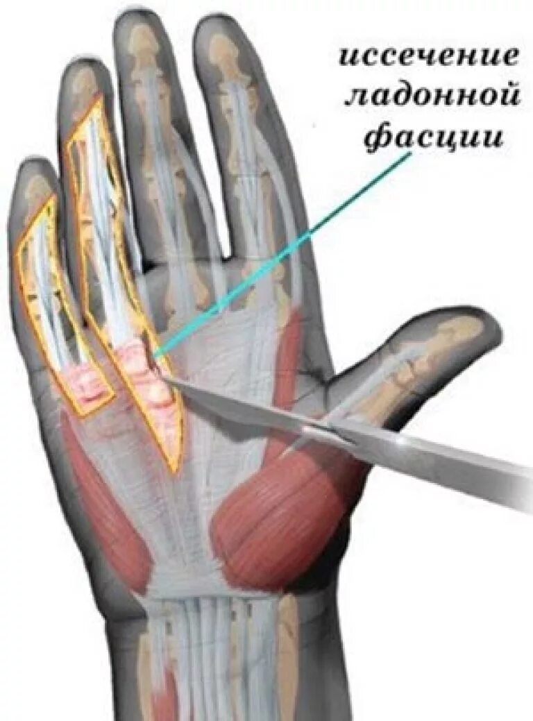 Контрактура Дюпюитрена операция. Контрактура сухожилий кисти. Контрактура Дюпюитрена кисти операция. Контрактура Дюпюитрена болезнь Нотта. Операция на большом пальце руки