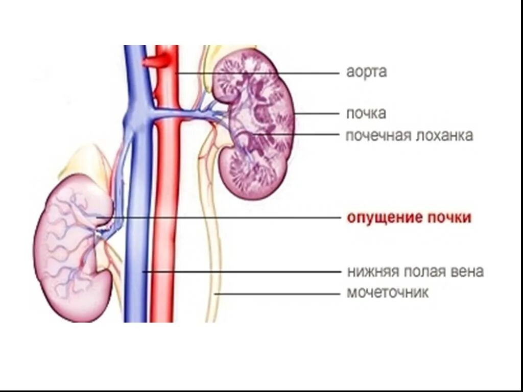 Мочеточник справа. Нефроптоз опущение почки. Нефроптоз почек 2 степени. Нефроптоз 1 степени правой. Опущение почки 1-2 степени лечение.