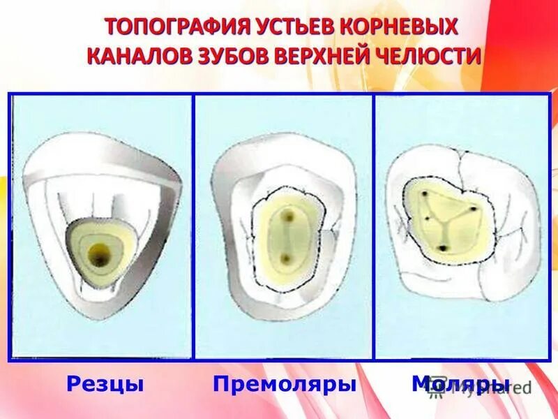 Анатомия устьев корневых каналов зубов. Анатомия устьев корневых каналов 26 зуба. Топография устьев корневых каналов.