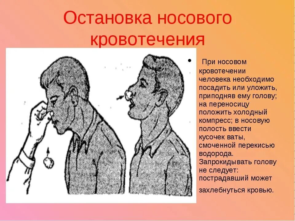 С носовым кровотечением следует. Остановка носового кровотечения. Остановка родового кровотечения. Остановка кровотечения из носа. Остановкакровотеечния износма.