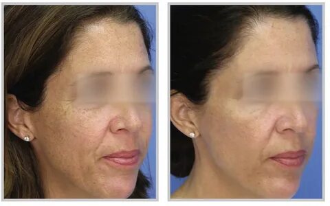 Лазерная шлифовка кожи skinlift