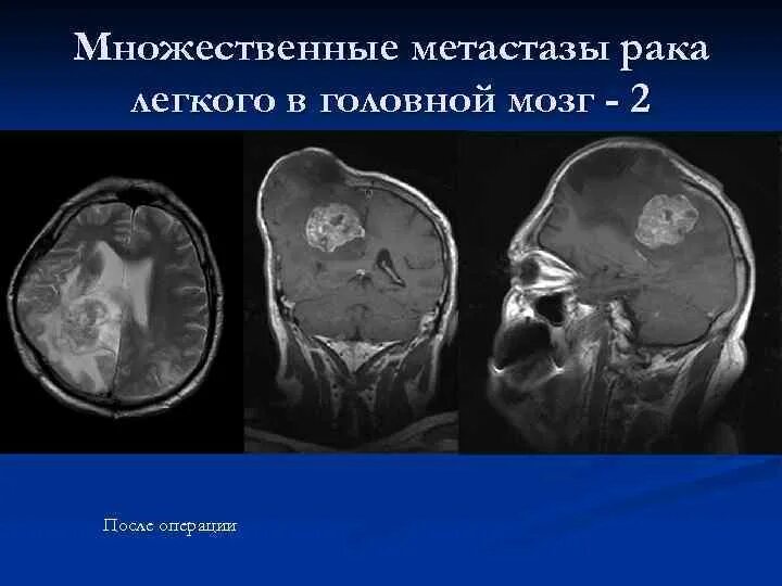 Лечение метастазов мозга. Множественные метастазы в головной мозг. Метастатические опухоли головного мозга. Опухоль головного мозга метастазы.