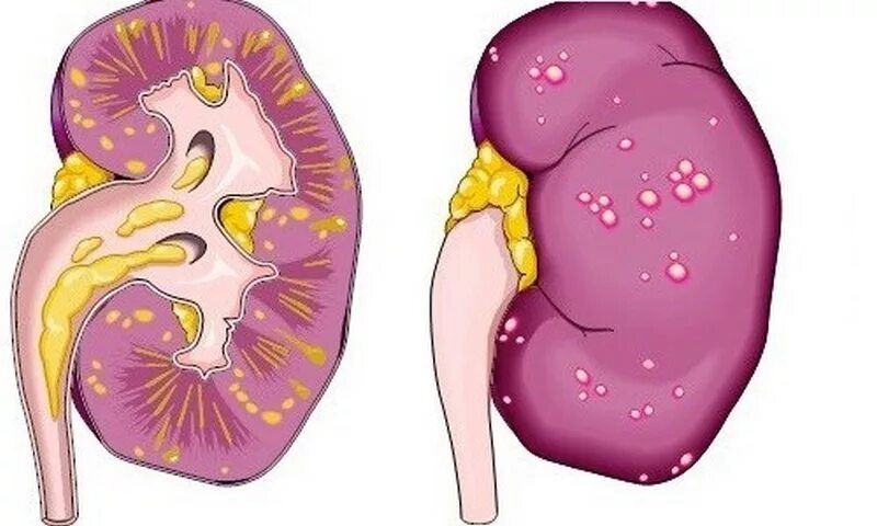 Воспаление почек заболевание. Апостематозный пиелонефрит. Апостематозный нефрит.