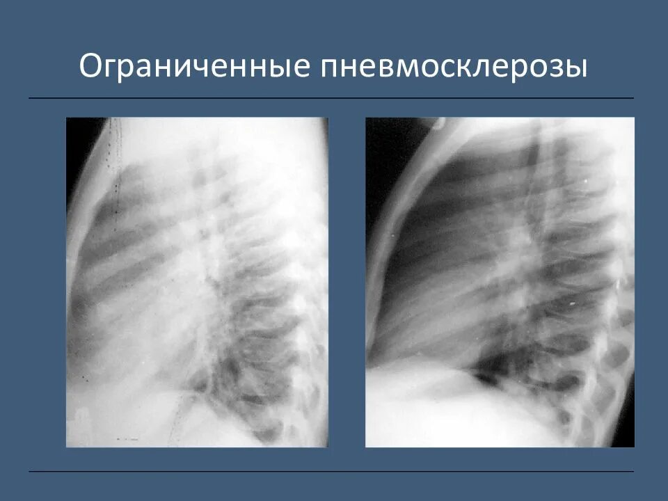 Рентген легких очаговый пневмосклероз. Постпневмонический пневмосклероз. Рентген признаки пневмофиброза. Очаговый пневмосклероз рентген.