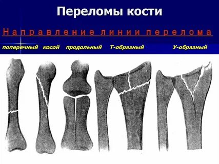 Линия перелома прослеживается