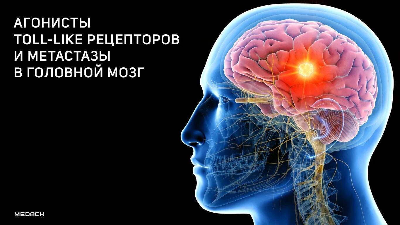 Мозг и рецепторы. Метастазы в головном мозге. Рецепторы головного мозга. Инсульт при метастазах в головном мозге. Мозг терапия купить