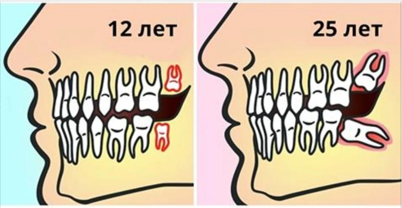Как долго растут зубы мудрости