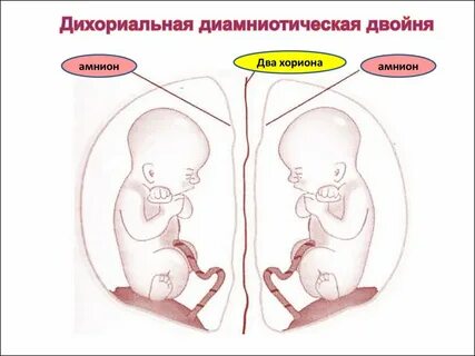 Монохориальная двойня
