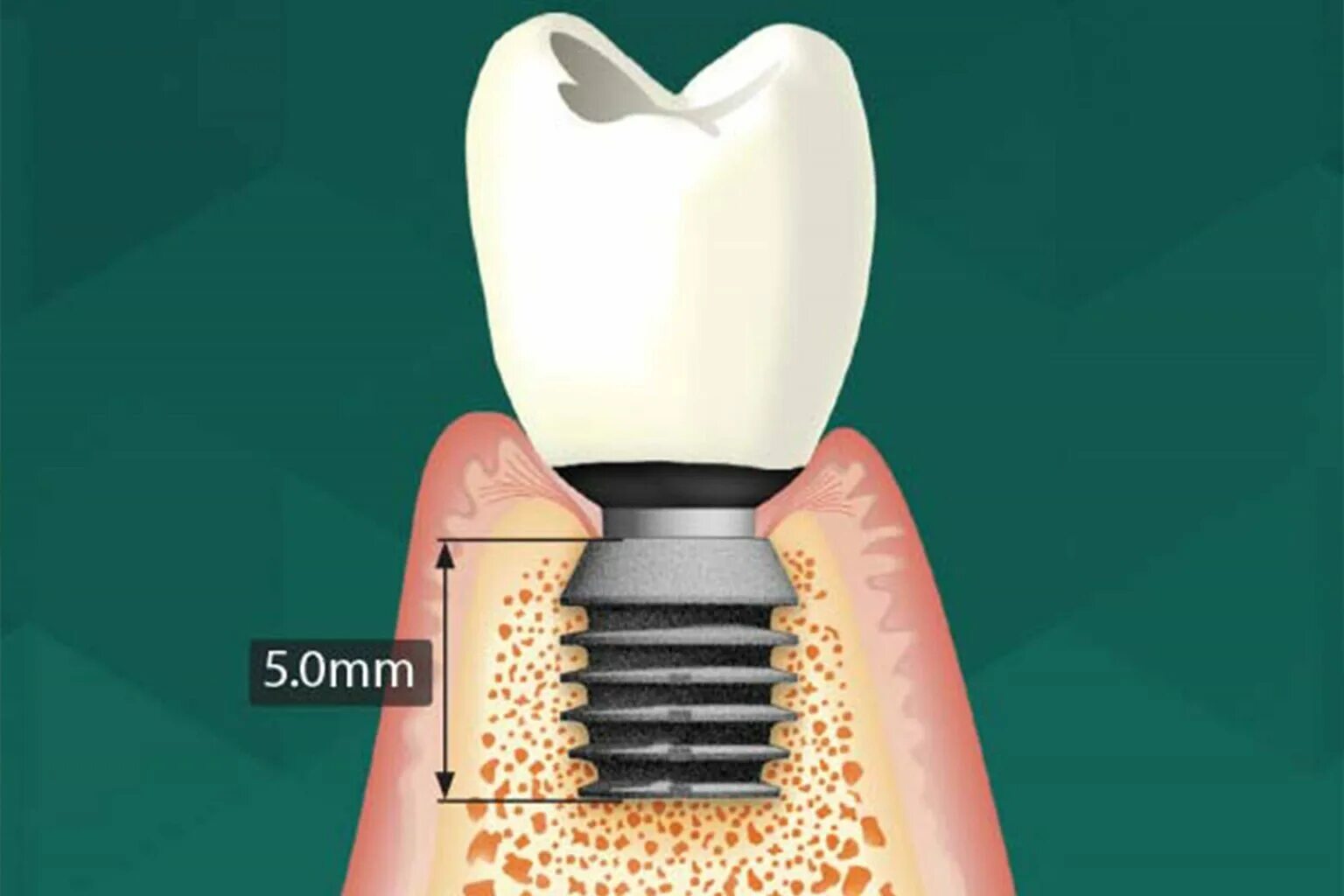 Имплантаты Байкон. Имплантат "bicon Dental Implants". Система имплантов Байкон. Абатмент bicon. Имплантация sup aznona com