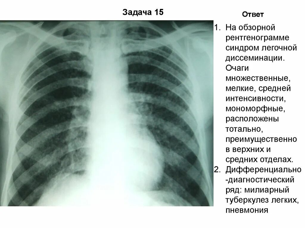 Очаг в верхней доле правого легкого. Синдром диссеминации на рентгенограмме. Синдром легочной диссеминации рентген. Синдром милиарной диссеминации туберкулез. Легочная диссеминация.