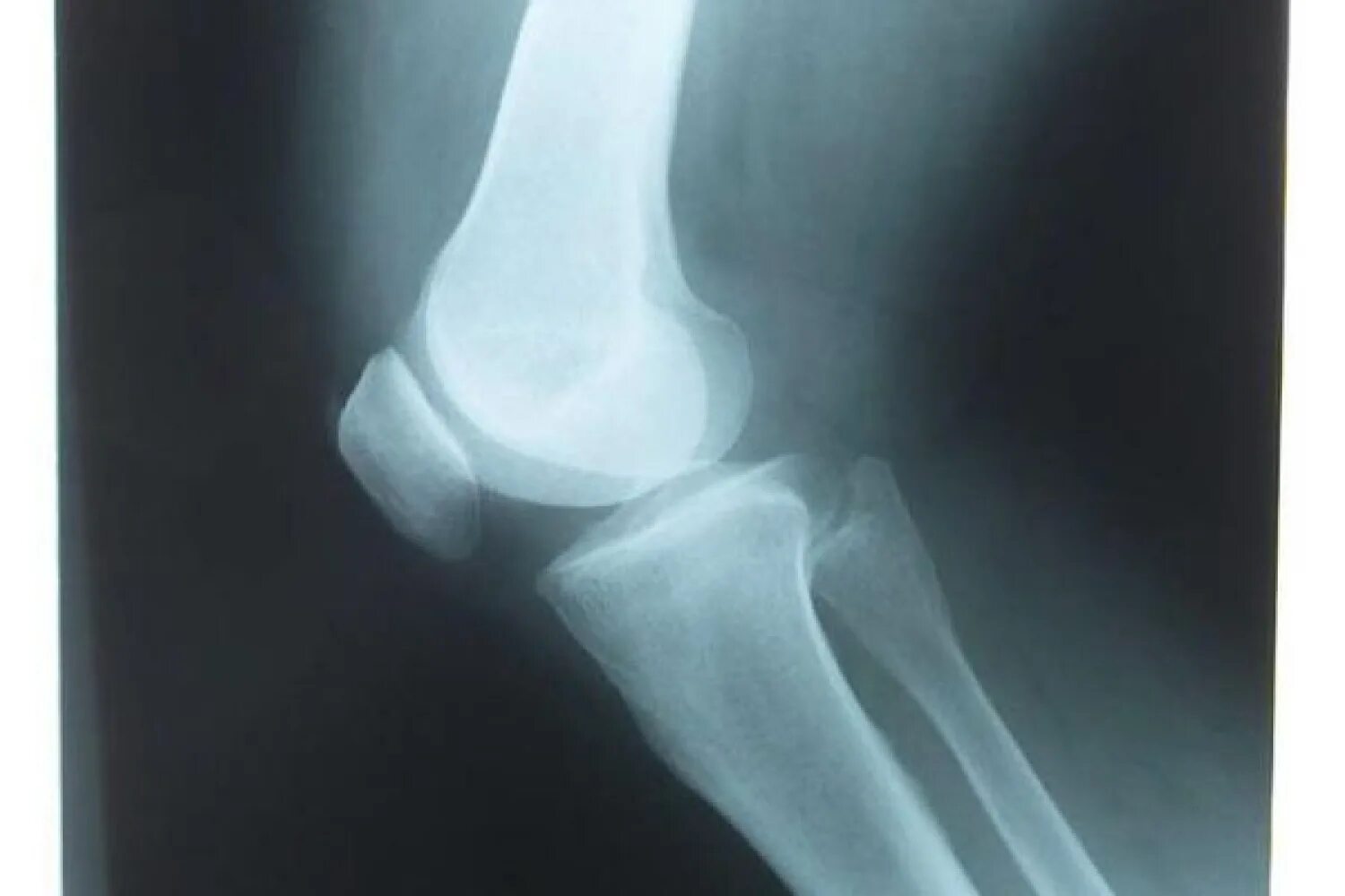Перелом надколенника рентген. Перелом коленного сустава рентген. Рентген колена перелом надколенника.