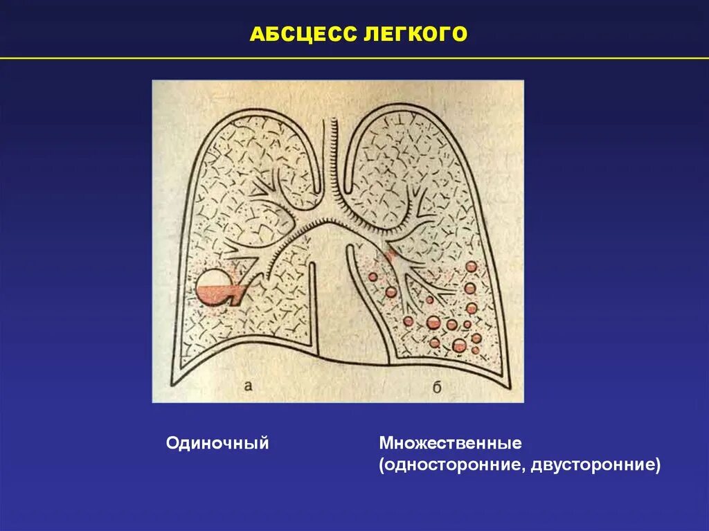 Множественный абсцесс легкого. Множественные абсцессы легких. Периферический абсцесс легкого это. 1 абсцесс легкого