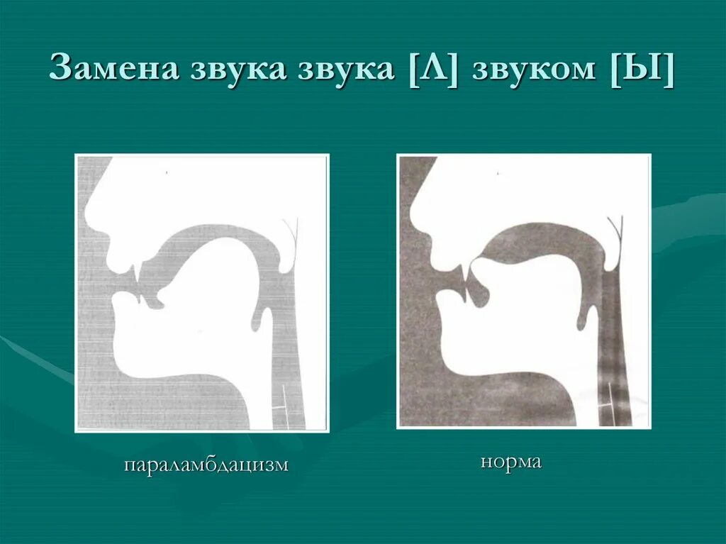 Артикуляция определение. Артикуляция звука л. Носовой ламбдацизм. Артикуляционный профиль звука л и ль. Носовой ламбдацизм звука л.