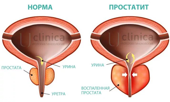 Простата действий. Секрет предстательной железы. Секрет предстательной железы у мужчин.