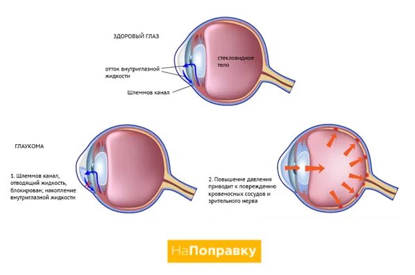 Глазная операция глаукомы. Операция при катаракте и глаукомы. Глаукома и катаракта операция. Катаракта при глаукоме.