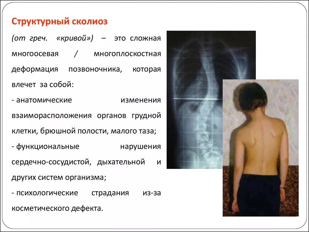 Структурный сколиоз 2 степени. Неструктурный сколиоз 1 степени. Признаки сколиоза 1 степени. Сколиоз 2 степени это