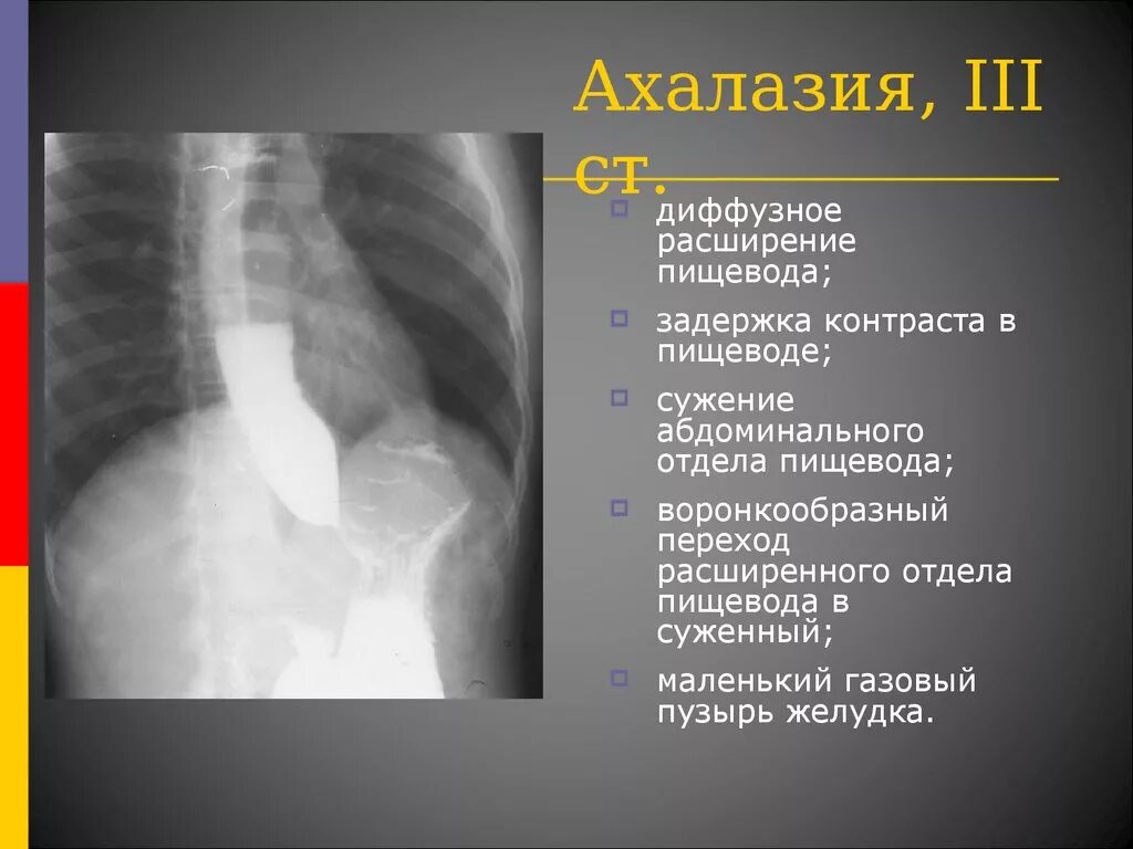 Дилатация пищевода